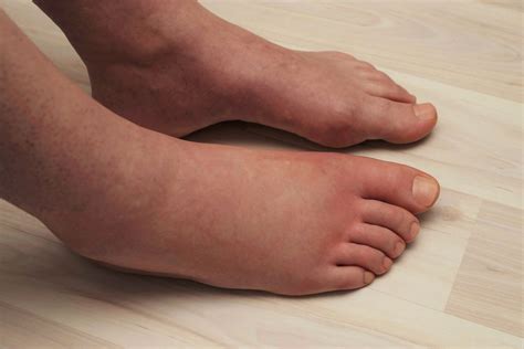 foothubnd|What Does One Swollen Foot Mean .